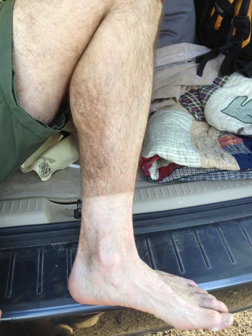 A fake farmer's tan caused by dirt